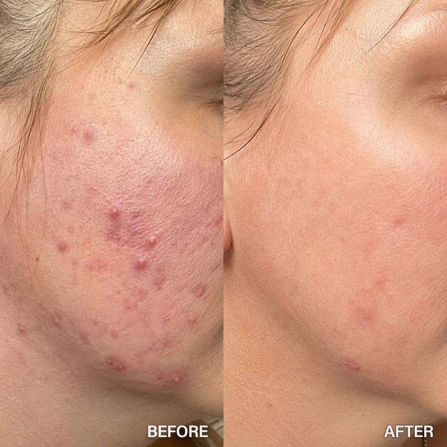 Before and after comparison of acne-prone skin on a person's face.
