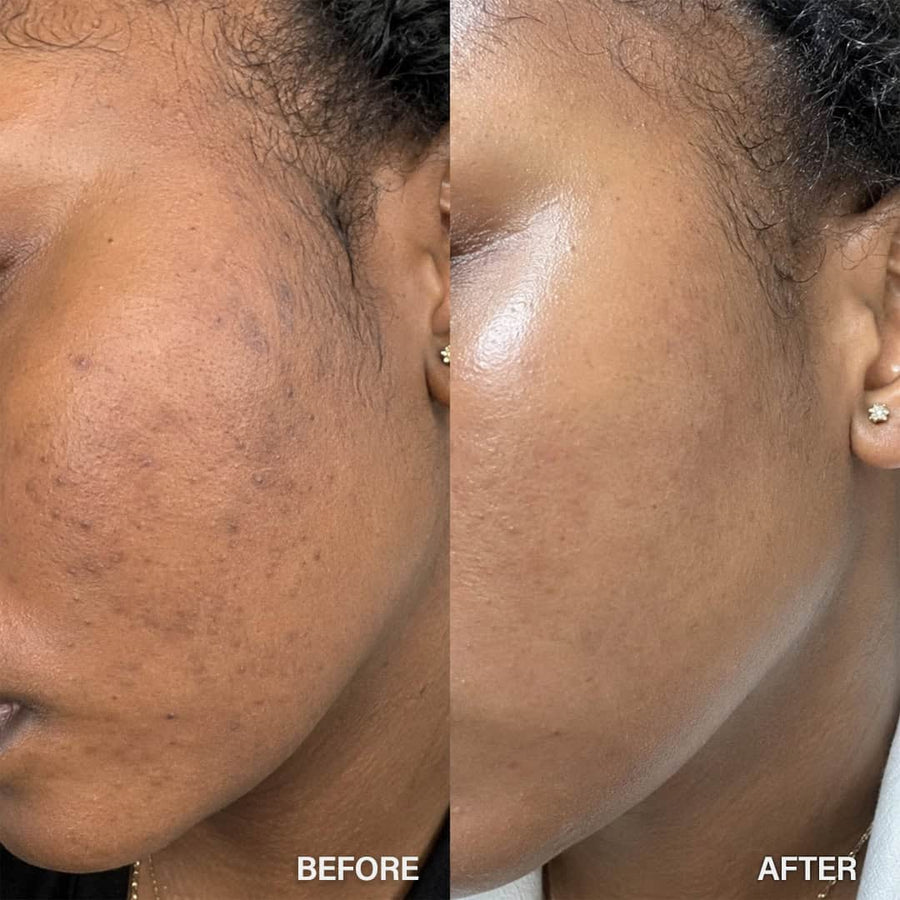 Before and after comparison of a person's face with visible skin texture changes.